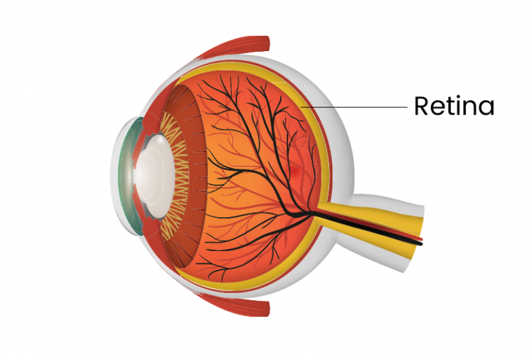 Descolamento De Retina Instituto De Mol Stias Oculares