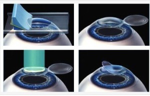 Cirurgia de catarata a laser reduz o medo do paciente 5 01