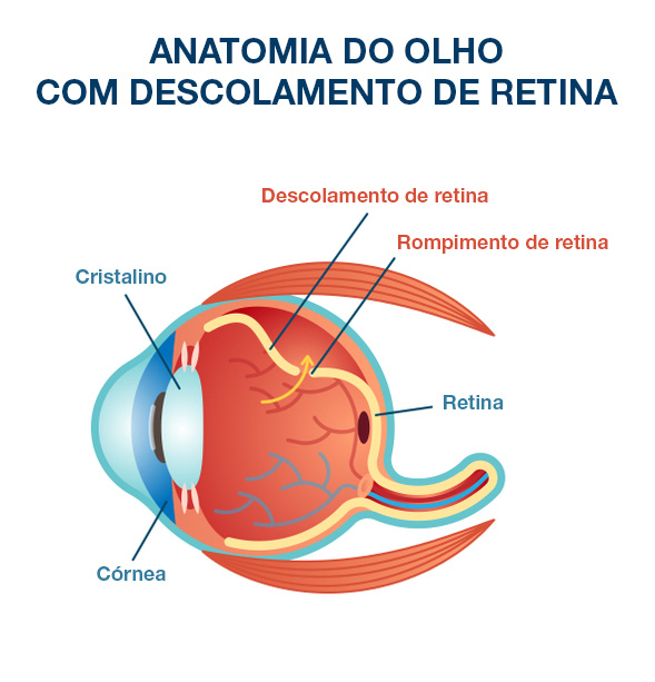 Descolamento da Retina  Oculari Hospital Oftalmológico