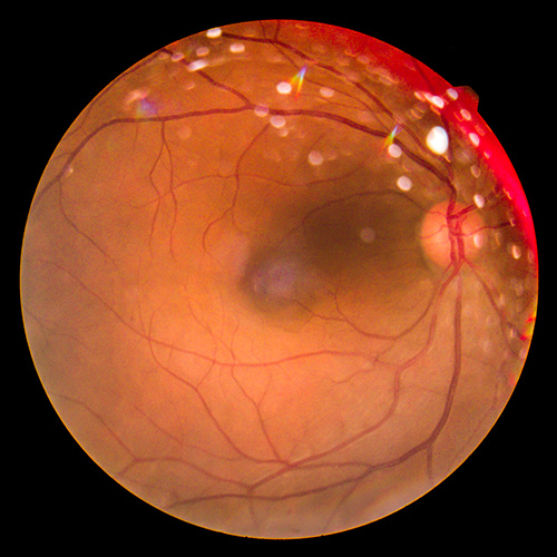 retinopatia diabetica imo