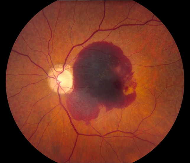 retinopatia hipertensiva imo 2